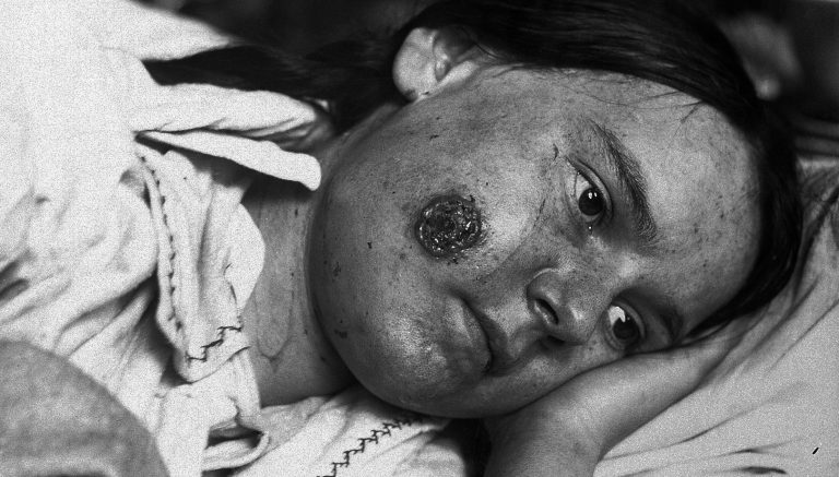 antrace lesioni indigeni america batterio