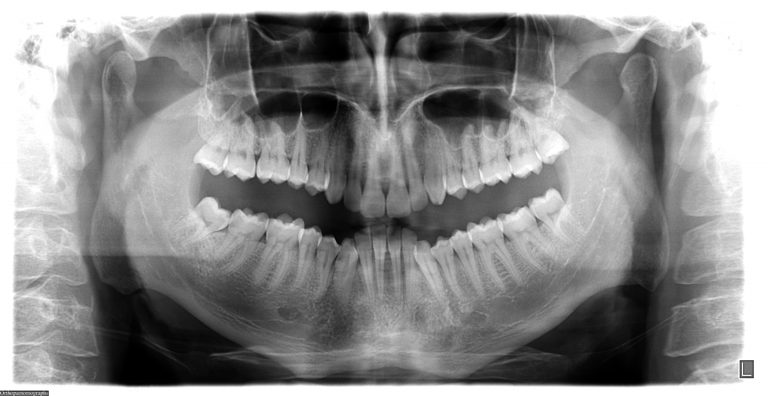 Staminali dai denti del giudizio