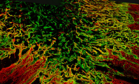 Chemioterapia per lesioni al midollo spinale