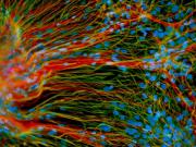 Parkinson: verso una terapia con le staminali