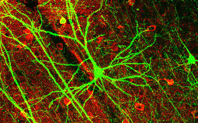 Sclerosi multipla: “stop alla campagna per Brave Dreams”