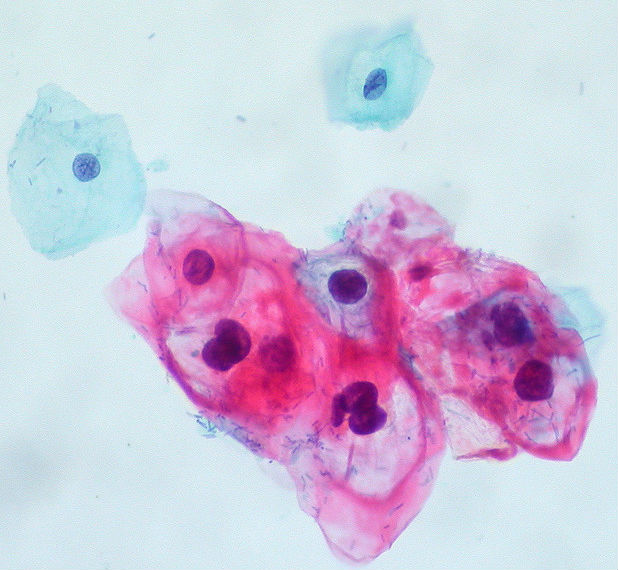 Tumori, uno su sei è colpa di un virus