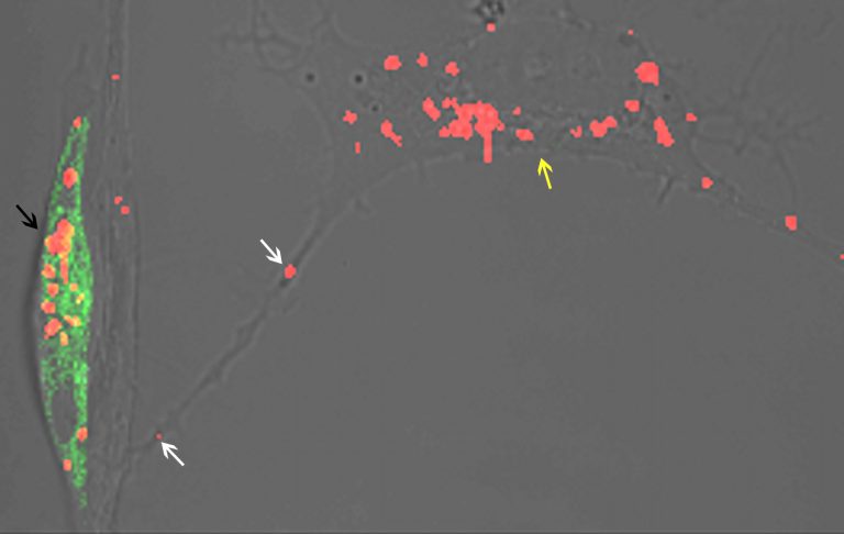 Come si diffonde l’Alzheimer tra i neuroni