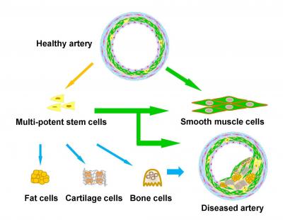 Arteriosclerosi, la colpa è delle staminali