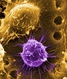 Staminali: stop alle cure anche dal Tar. Ma Celeste continuerà