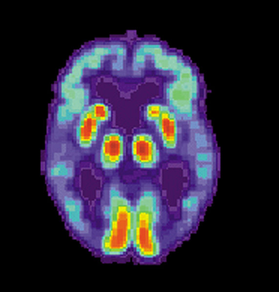 Alzheimer: a due velocità in uomini e donne
