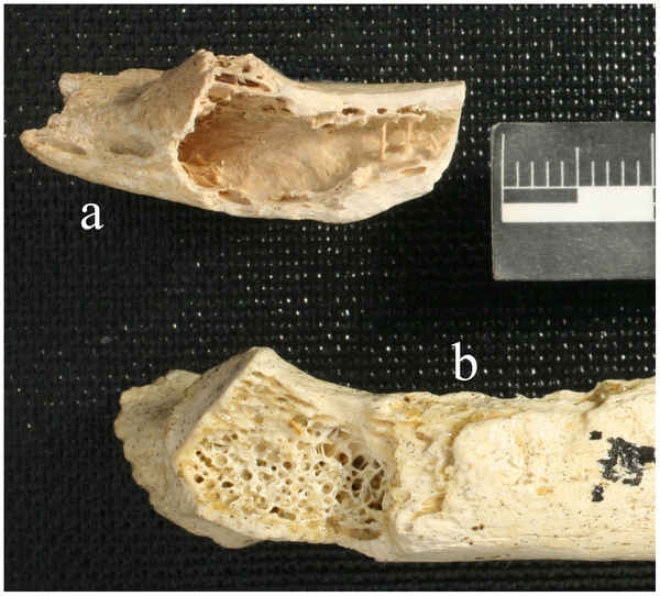 Il cancro al tempo dei Neanderthal