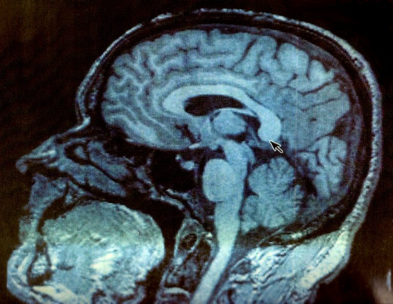 Perché l’autismo è più comune nei maschi?