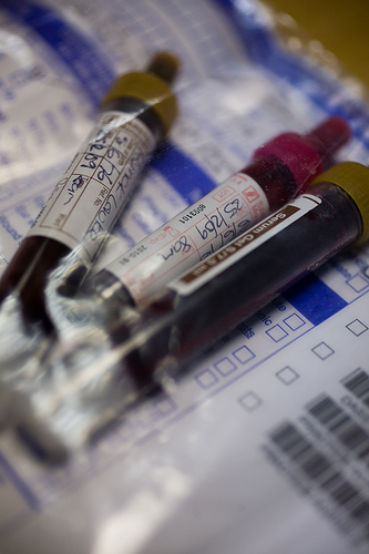 Un nuovo test del sangue per scoprire l’Alzheimer