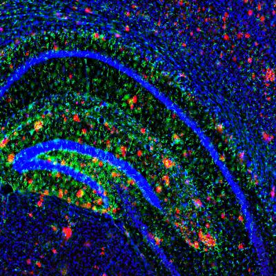 Antidepressivi contro l’Alzheimer?