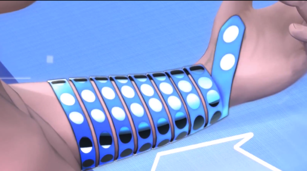 Un bypass neurale per curare le paralisi