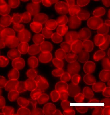 Una terapia genica per la talassemia
