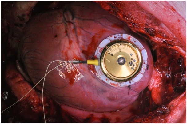 Il pacemaker che funziona come un orologio automatico