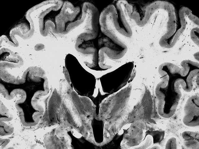 Parkinson: un nuovo strumento per la diagnosi precoce