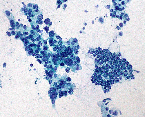 Cancro al pancreas, il ruolo della genetica