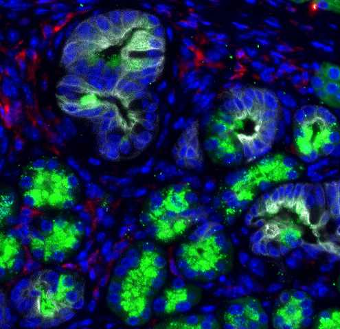 Così ha inizio il cancro al pancreas