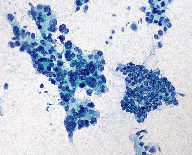 Una terapia mirata per il cancro al pancreas
