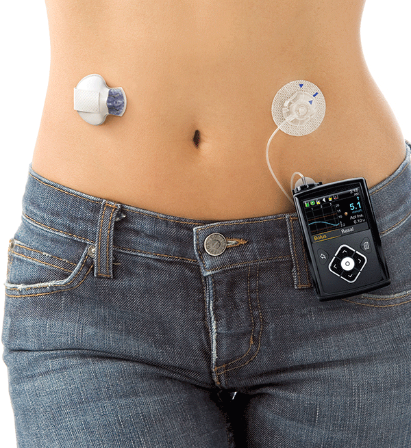 Diabete: arriva il sistema smart che previene l’ipoglicemia