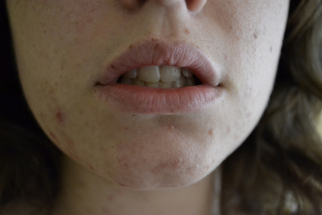 Acne, colpa di troppa vitamina B12?