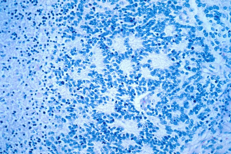 Neuroblastoma: l’immunoterapia, per ora, non basta