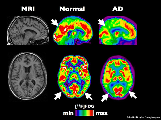 Alzheimer: è possibile la trasmissione tra esseri umani?