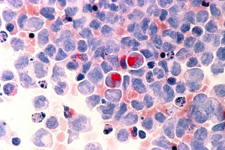 Immunoterapia contro la leucemia linfatica