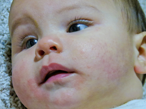 Eczema atopico: ecco altre 10 varianti genetiche