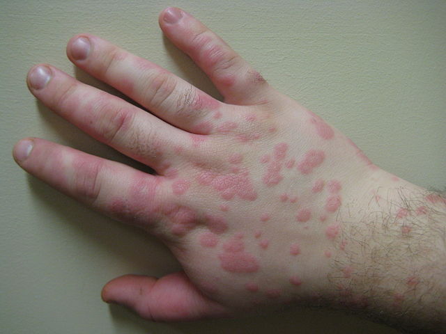 dermatite allergica professionale occupazionale