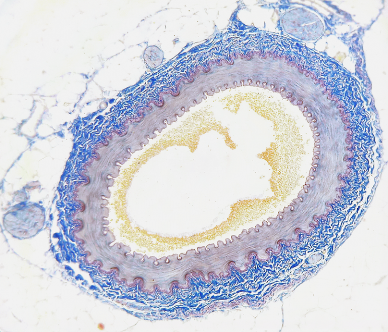Ipercolesterolemia familiare, una malattia ignorata
