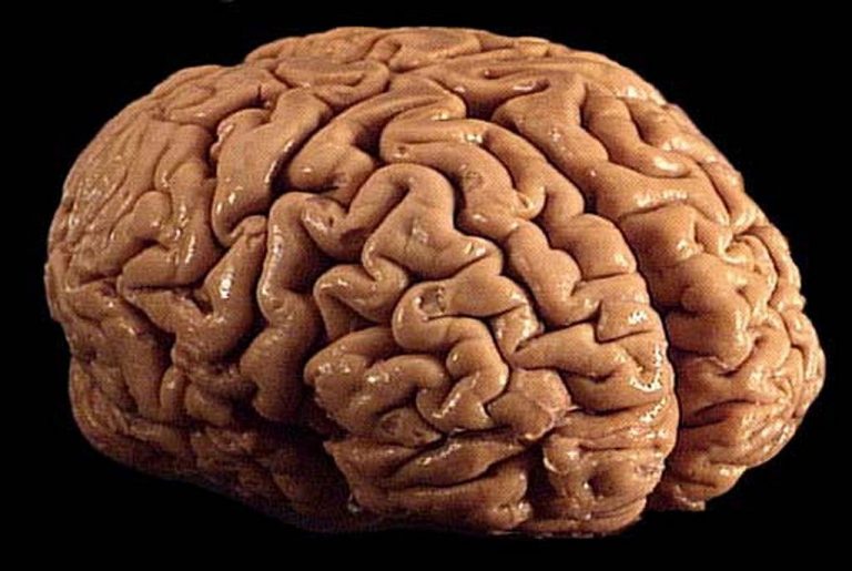 Parkinson: svelato il legame con il ferro