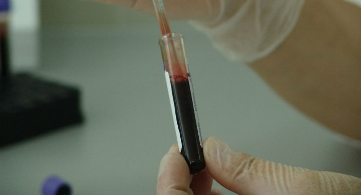 Contro i tumori, colpire il proteasoma e la proteina p53