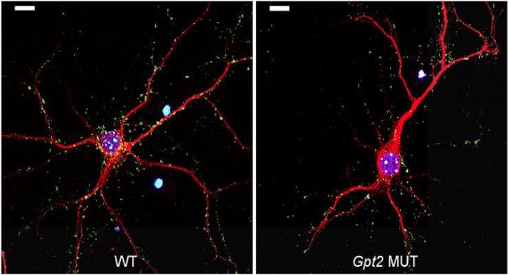 Scoperti i meccanismi di una nuova malattia neurologica