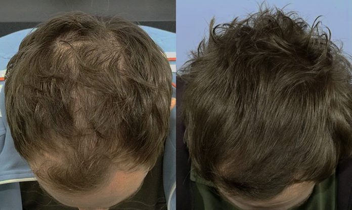 hairclinic hCRP Sonicato