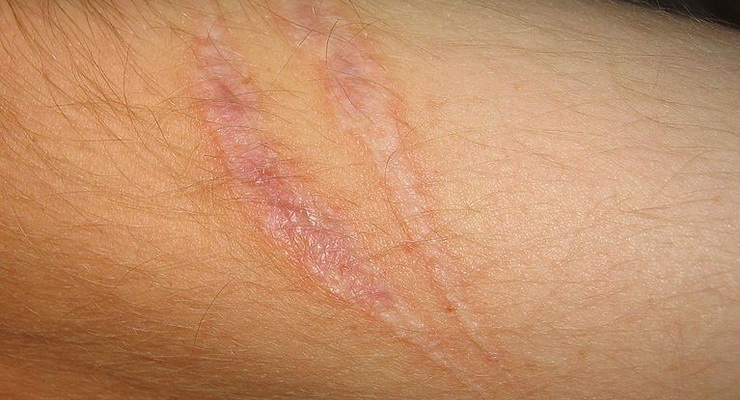 Come far guarire le ferite senza lasciare cicatrici