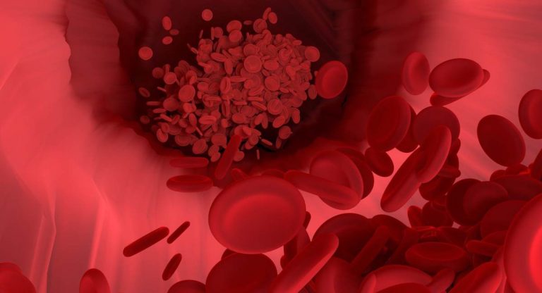 aneurisma covid coronavirus polmonite microcoaguli coaguli del sangue