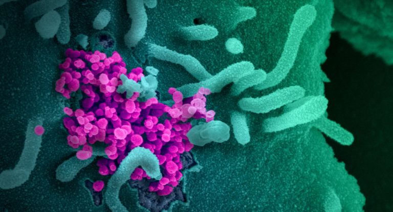 covid coronavirua elettroencefalogrammi encefalopatia ictus mal di testa convulsioni epilessia sintomi neurologici