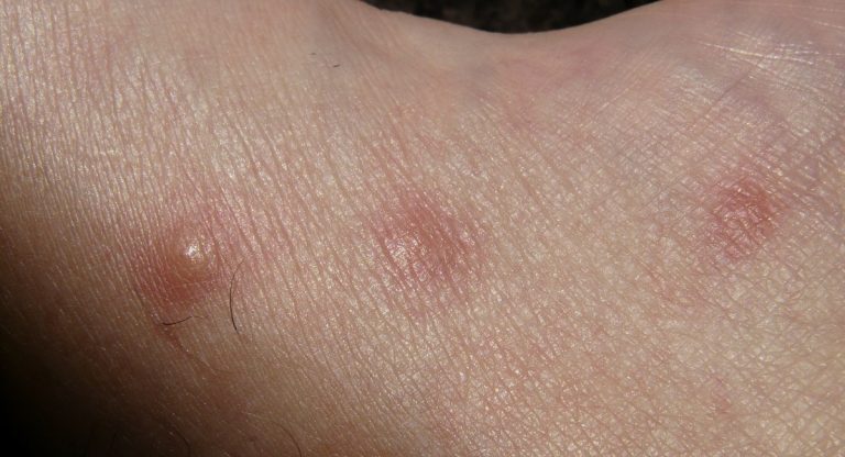 covid coronavirus pelle sintomi rash arrossamenti vesciche geloni