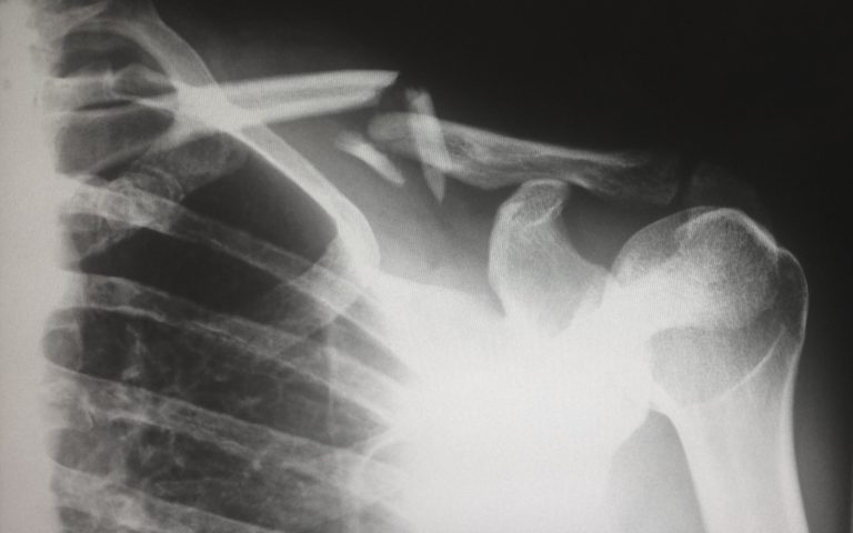 osteoporosi