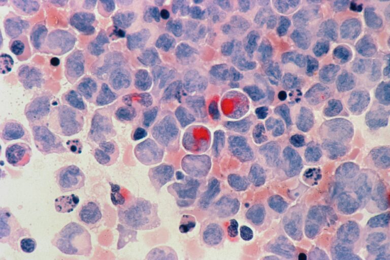 cancro