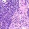 Adenocarcinoma polmonare, cosa è il tumore che ha colpito il Papa